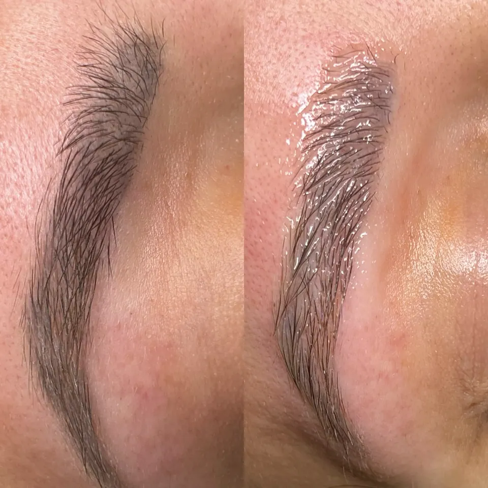 Cosmetic Tattoo Removal at Bella Beauty Brazil in Greenslopes