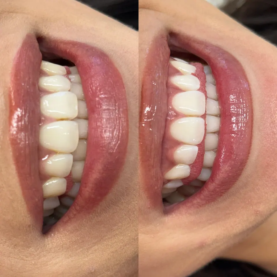 Teeth Whitening at Bella Beauty Brazil in Greenslopes